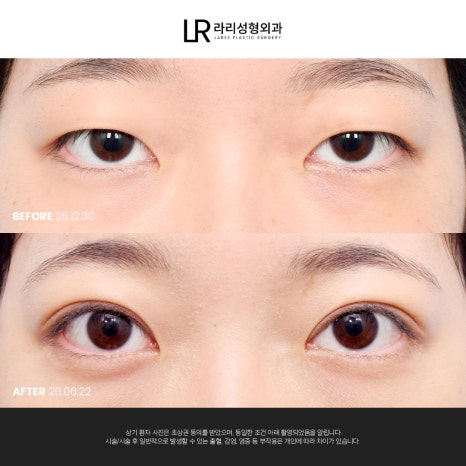 [라리성형외과] 쌍꺼풀수술 전후 사진으로 보는 눈매교정의 중요성 관련 이미지 5