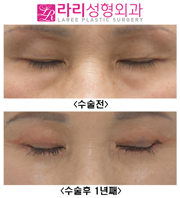 [Lari Plastic Surgery] Upper eyelid surgery, non-epicanthic inner corner surgery, revision outer corner surgery, and lower eyelid fat repositioning can all be done at once. Recovery with good results is possible! image 5