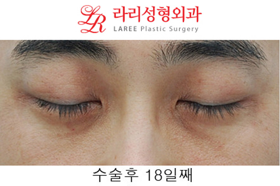 Under-Eye Fat Repositioning Before and After in Your 40s image 4