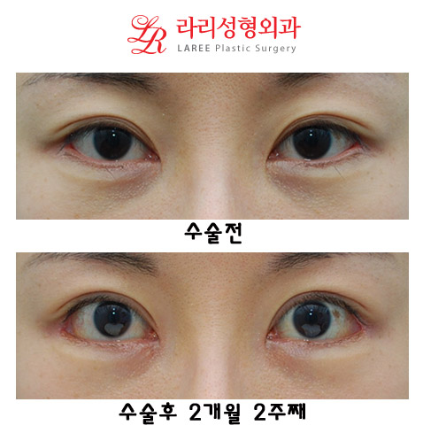 쌍꺼풀재수술(쌍꺼풀낮추는수술),뒤트임재수술,트임없는앞트임 관련 이미지 1