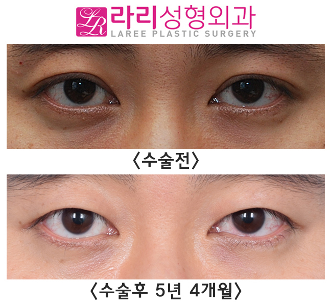 [라리성형외과] 쌍꺼풀없애는수술 단기 회복부터 장기 경과까지 관련 이미지 6