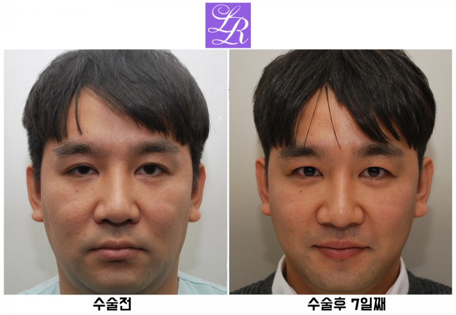 쌍꺼풀푸는수술 후기 - 수술후 1주일차 붓기, 멍 경과 관련 이미지 1