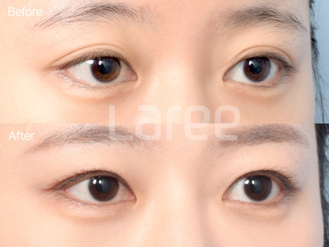 [Lari Plastic Surgery] Everything About Double Eyelid Removal Surgery image 10