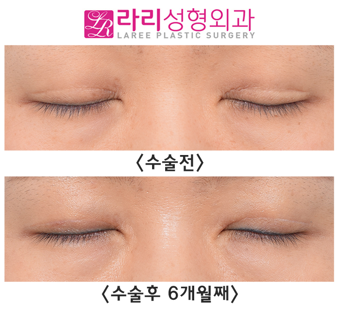 [라리성형외과] 흐릿한 눈, 소세지 쌍꺼풀 인라인 속쌍으로 깔끔하게 관련 이미지 3