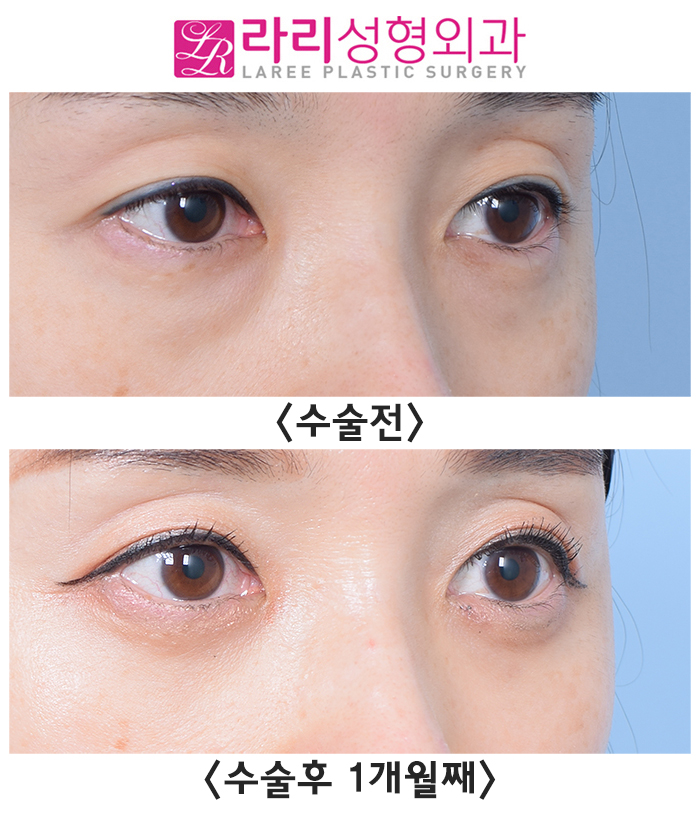 [라리성형외과] 눈밑지방재배치수술로 근본적인 문제를 해결하자(레이저보다 확실한 방법) 관련 이미지 3