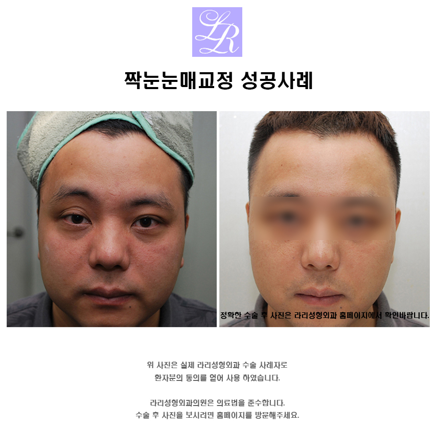 What Should You Check Before and After Male Eye Shape Correction? image 4