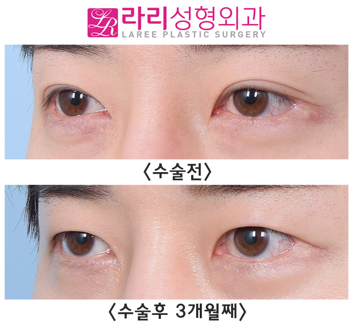 [Lari Plastic Surgery] Surgery to Remove Double Eyelids: Can It Really Make Double Eyelids Disappear? "YES!" image 2