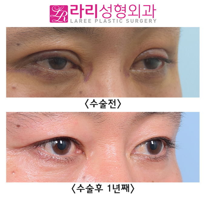 [라리성형외과] 급속교정 쌍꺼풀재수술 필요한 눈, 가능한 관련 이미지 2