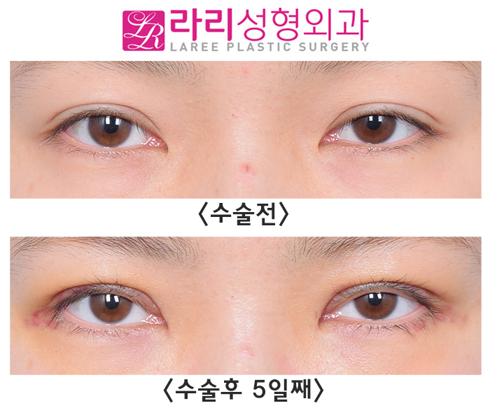 [라리성형외과] 쌍꺼풀재수술 라인낮추기 회복 기간 필수! 관련 이미지 3