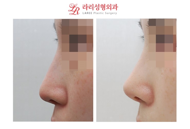 Revision Rhinoplasty for a Drooping Nose & Revision Surgery for a Drooping Nasal Tip
Long Nose & Long Nasal Tip Revision Surgery Before-and-After Photos image 2