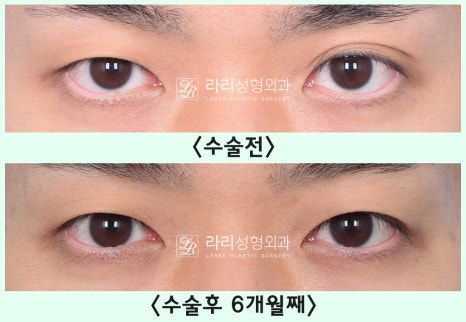[Lari Plastic Surgery] Removing a Visible Double Eyelid (Double Eyelid Reversal Surgery), From Natural Double Eyelids to Surgical Double Eyelids: A to Z image 10