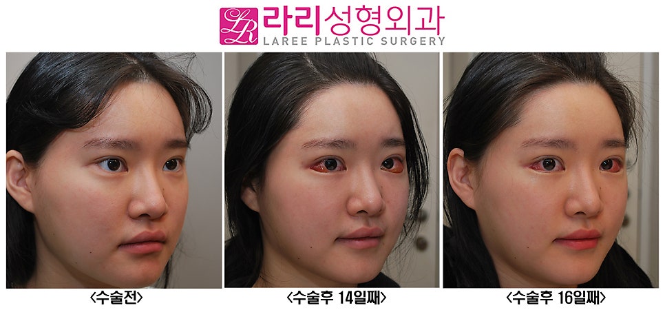[Rari Plastic Surgery] About Conjunctival Edema After Canthoplasty.. (Causes and Management) image 4
