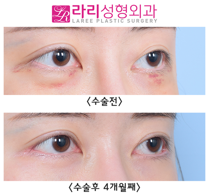 [Lari Plastic Surgery] Revision Double Eyelid Surgery: Micro Line Reduction, Micro Outer Corner Adjustment - Natural as if Nothing Was Done image 3