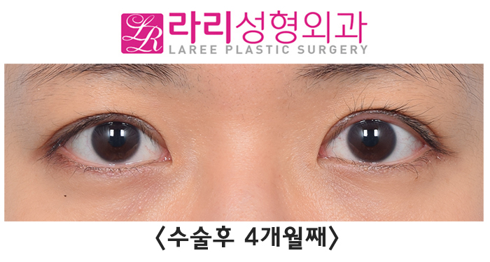 [라리성형외과] 겹주름 쌍꺼풀을 잘 없애려면 피할 수 없는 상안검외반, 좋아질 수 있어요. 관련 이미지 7