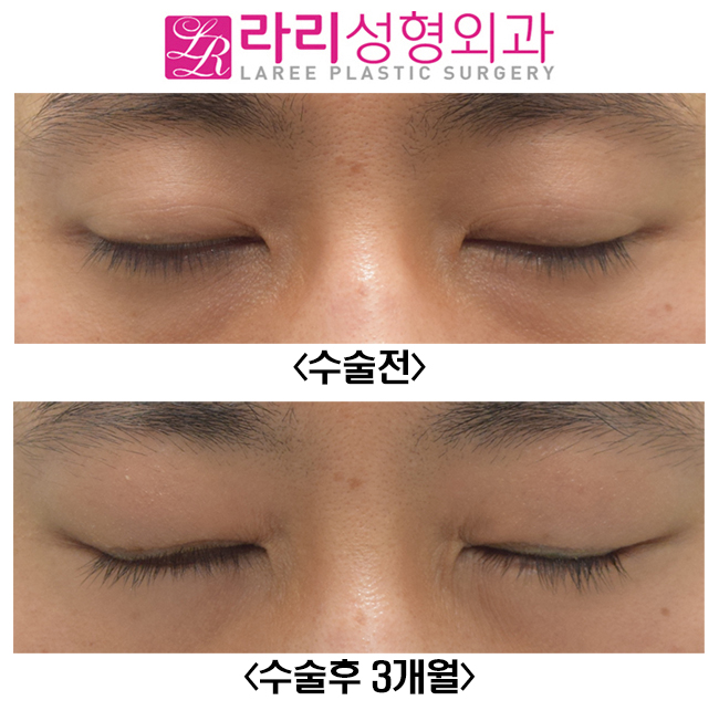 [라리성형외과] 쌍꺼풀없애기와 함께 한 윗눈꺼풀 패임 교정, 눈두덩이(Roof) 지방이식수술 전후사진 관련 이미지 5