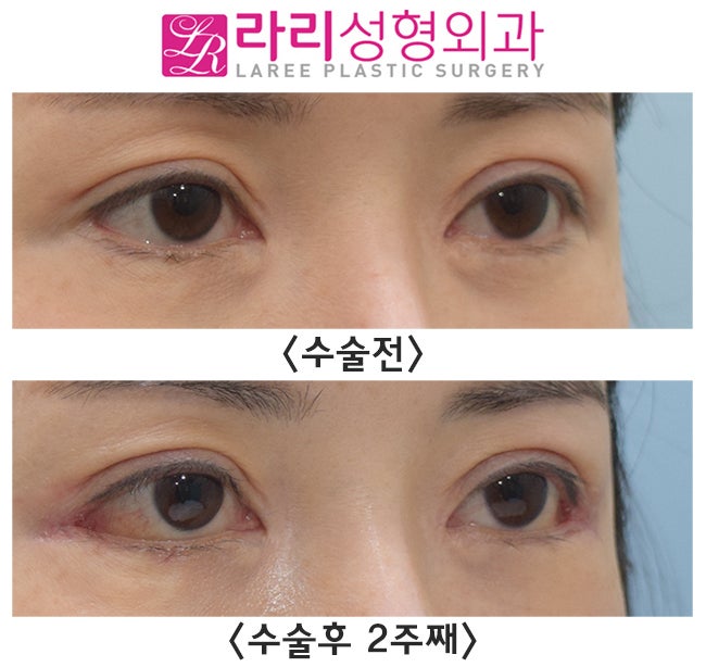 [라리성형외과] 뒤트임수술 단기경과, 결막부종 없이 회복이 빠 경우도 있어요. 관련 이미지 2