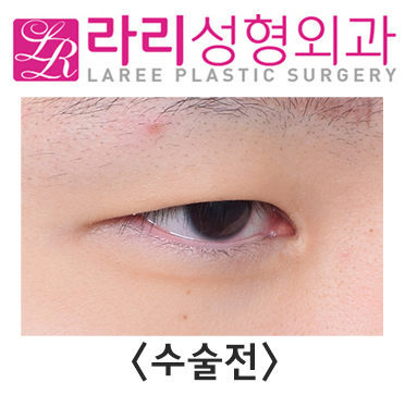 [Rari Plastic Surgery] Pre- and Post-Operation Photos of Uneven Double-Eyelid Correction and Double-Eyelid Removal on Different Sides image 2