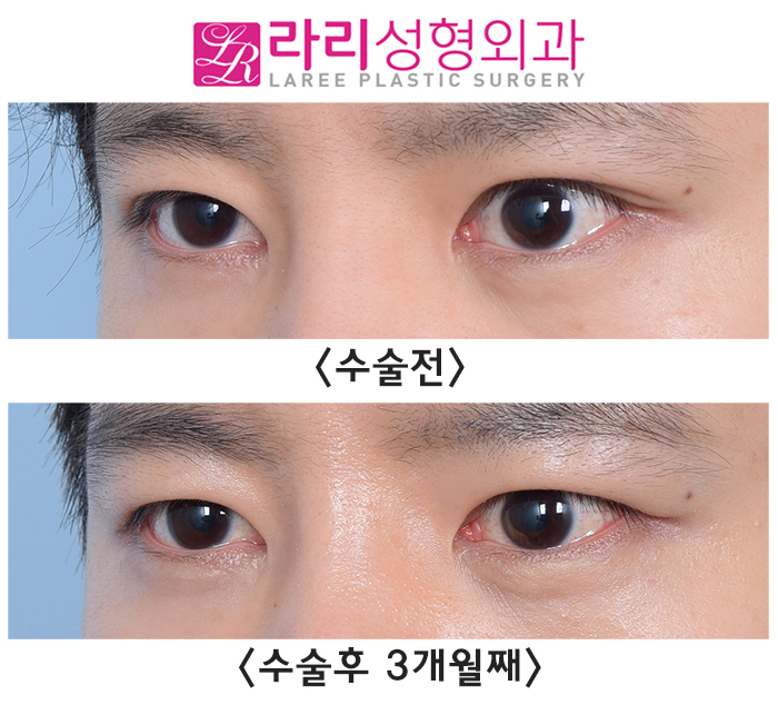 [라리성형외과] 눈매교정 부작용 토안 교정하면서 동시에 쌍꺼풀없애는수술까지 관련 이미지 2