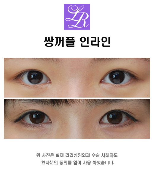 Eyes Suited to an In-Out Line Double Eyelid Design image 1