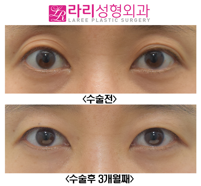 [라리성형외과] 윗눈꺼풀 주름 같은 애매한 쌍꺼풀 무쌍 만드는 수술 관련 이미지 1