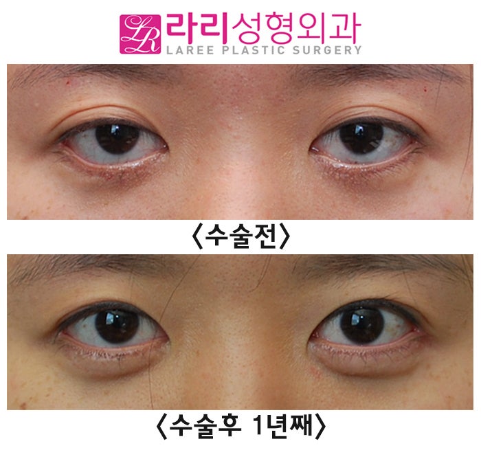 [Rari Plastic Surgery] Eyelid Ectropion Correction Surgery Methods According to Eye Condition image 3