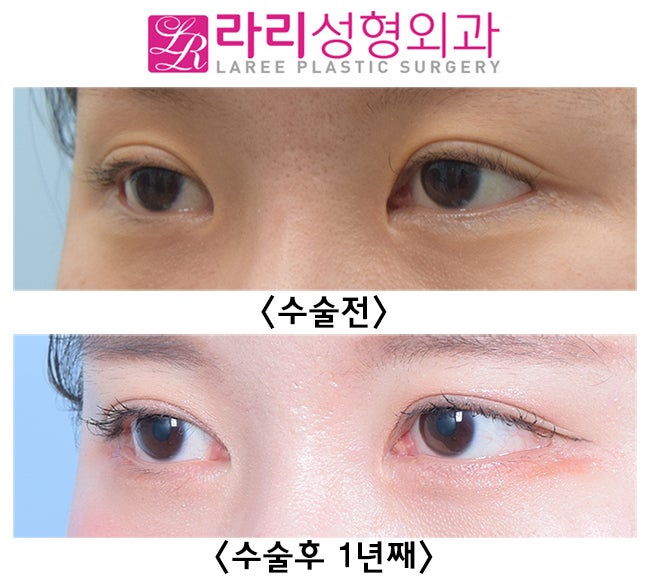 [Lari Plastic Surgery] Effective Revision Epicanthoplasty and Revision Canthoplasty: I Did Not Have Double Eyelid Surgery! image 3