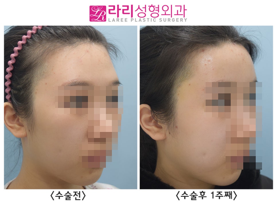 [Rari Plastic Surgery] Facial Fat Grafting (Forehead, Cheeks) Before-and-After Photos: 1-Week Progress image 1