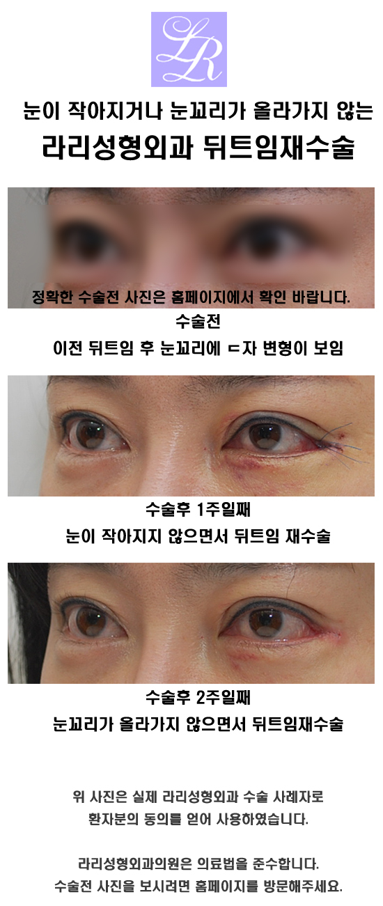 눈이 작아지지 않는 뒤트임재수술 관련 이미지 3