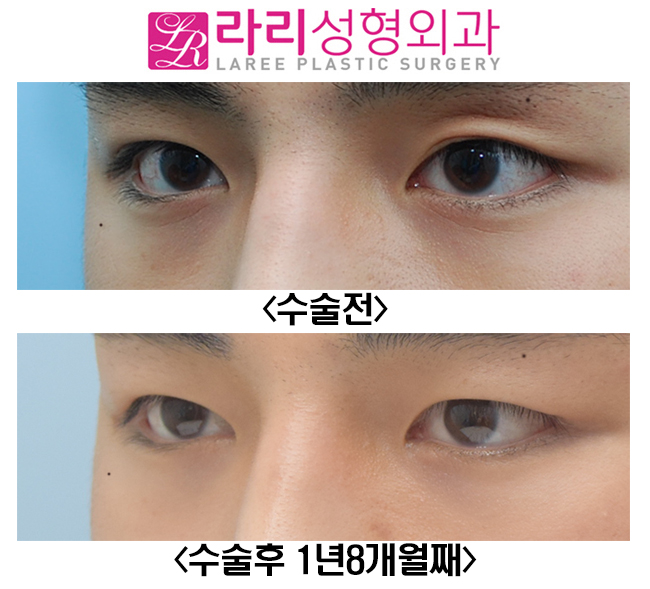 [라리성형외과] 쌍꺼풀없애기와 앞트임수술 전후사진 관련 이미지 5