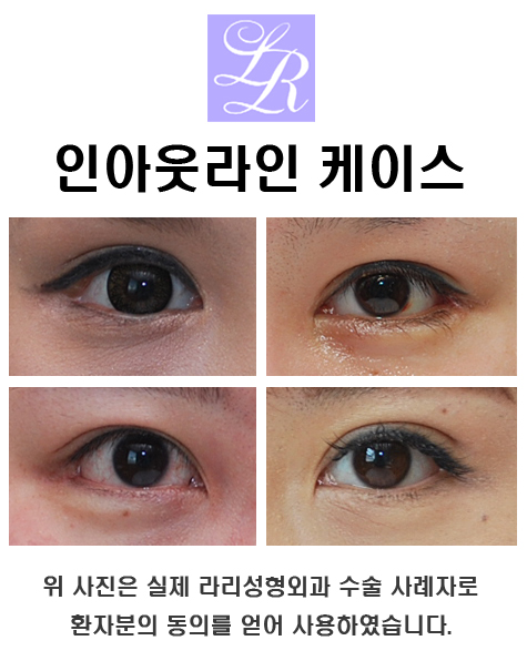 Eyes Suited to an In-Out Line Double Eyelid Design image 3