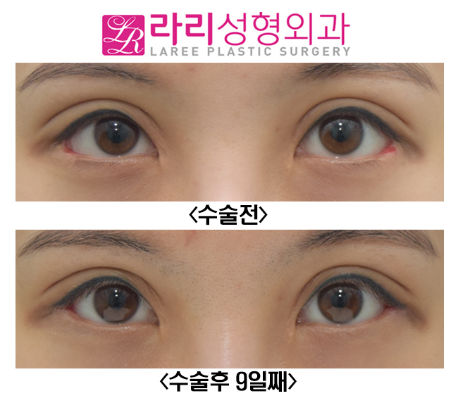 [라리성형외과] 다양한 뒤트임복원수술 전후사진 관련 이미지 3