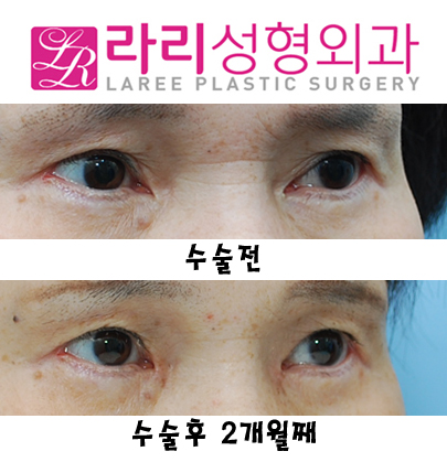 눈앞쪽 여러겹 쌍거풀없애기+뾰족한누호 둥글게 만들기 관련 이미지 4