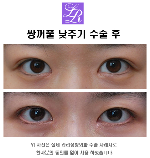 What Is the Way to Fix “Sausage Eyes” and “Sausage Double Eyelids”? image 3