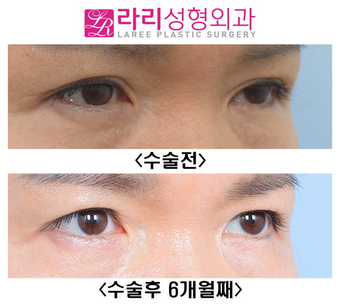 [라리성형외과] 여자도 쌍꺼풀없애기 - 함몰눈에 어울리는 눈 관련 이미지 2