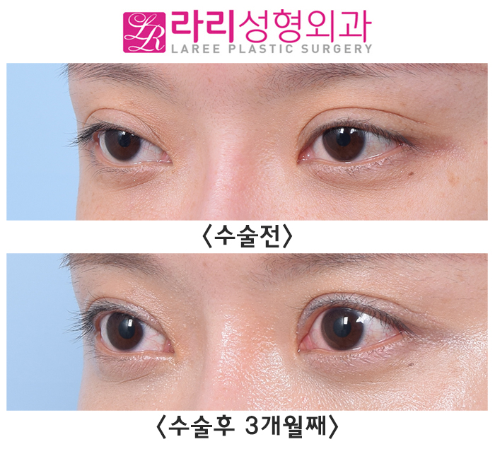 [Lari Plastic Surgery] Cases Where Revision Double-Eyelid Surgery Improves Scleral Show image 1