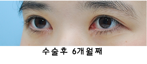 [라리성형외과] 절개쌍수 눈매교정 그리고 앞트임 관련 이미지 6