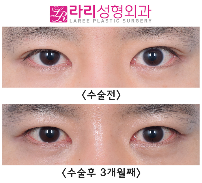 [라리성형외과] 눈매교정 부작용 토안 교정하면서 동시에 쌍꺼풀없애는수술까지 관련 이미지 1
