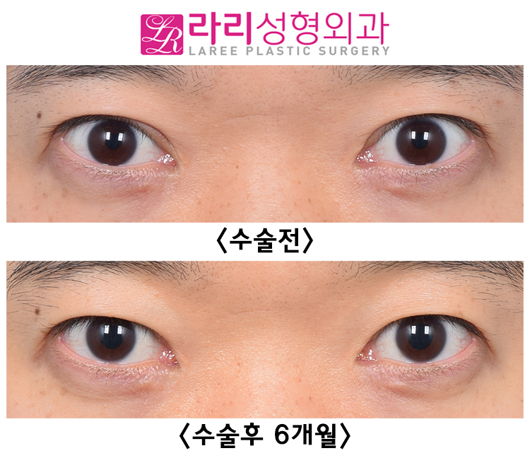 [LARI Plastic Surgery] The Best Time for Double-Eyelid Revision Surgery: Before and After Removing an Incisional Double-Eyelid Line One Year After Surgery image 3