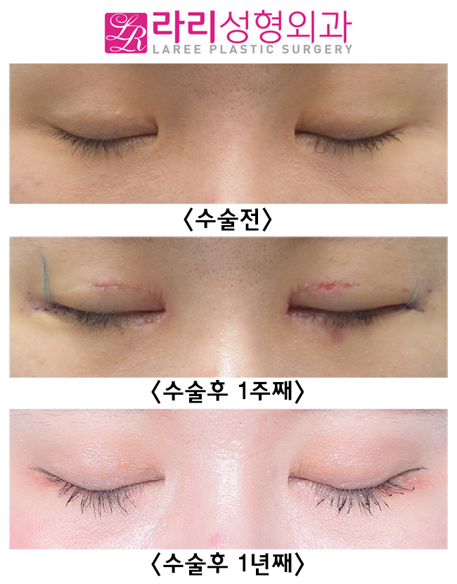 [Lari Plastic Surgery] Effective Revision Epicanthoplasty and Revision Canthoplasty: I Did Not Have Double Eyelid Surgery! image 4