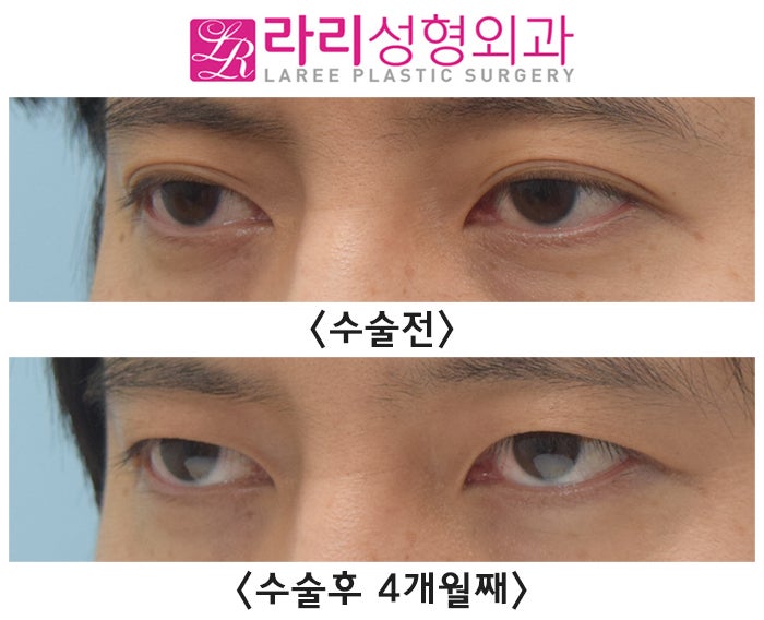 [라리성형외과] 자연쌍꺼풀 지워서 무쌍꺼풀 만드는 눈 수술 전후 사진 관련 이미지 5