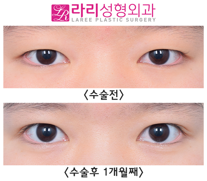 [라리성형외과] 비절개눈매교정 한 달 차 - 피부 절제 없이, 간단하고 또렷하게 관련 이미지 1