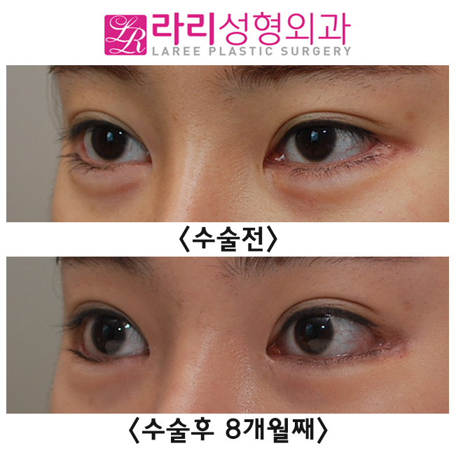 [라리성형외과] 벌어짐 없는 앞트임 미세복원 관련 이미지 3