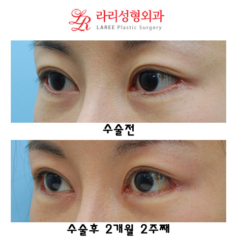 쌍꺼풀재수술(쌍꺼풀낮추는수술),뒤트임재수술,트임없는앞트임 관련 이미지 2