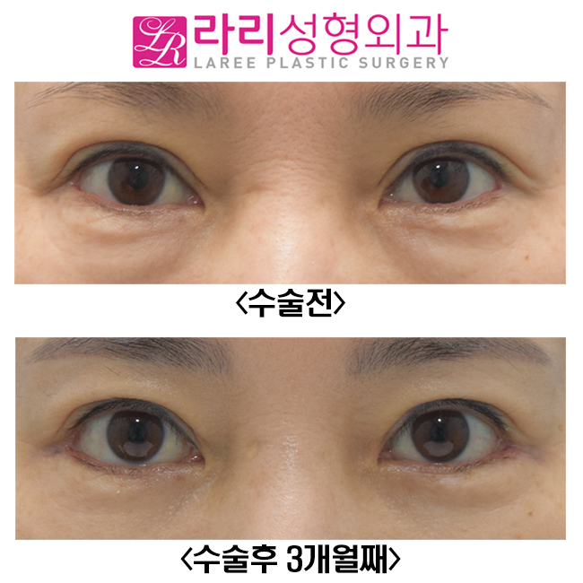 [Lari Plastic Surgery] Before-and-After Photos of Correcting Sausage-like Double Eyelids with Revision Double Eyelid Surgery image 1