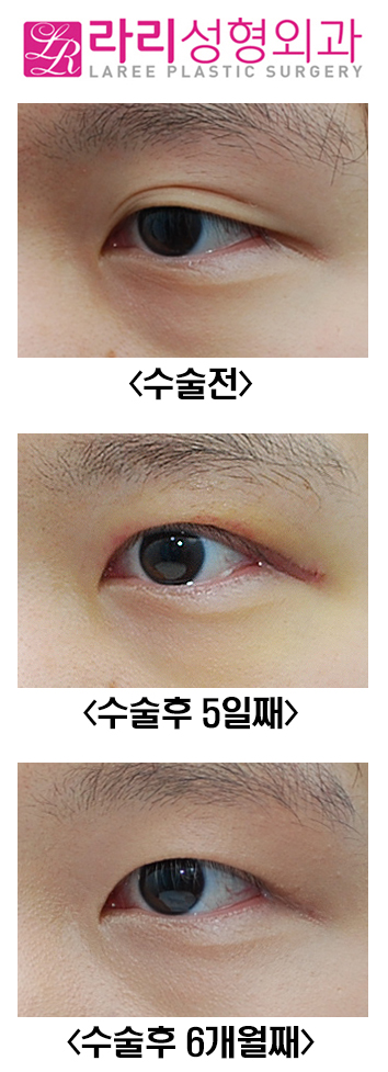 [Rari Plastic Surgery] Thick Natural Double Eyelid Removal Surgery: Before and Up to 6 Months After image 4