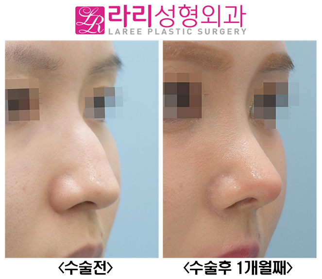 [라리성형외과] 매부리코수술, 무보형물로 자연스럽고 매끈하게 관련 이미지 2