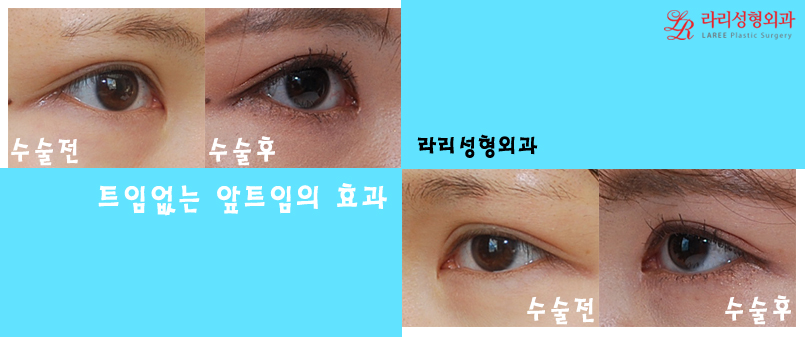 몽고주름, 더이상 헤매지말고 트임없는앞트임으로! 관련 이미지 5