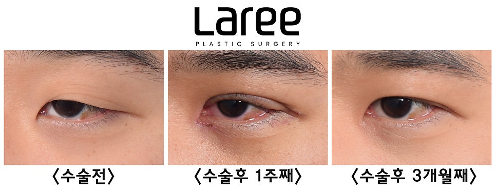 [Rari Plastic Surgery] After Eye Surgery, Is Mucosal Show Normal?! image 4