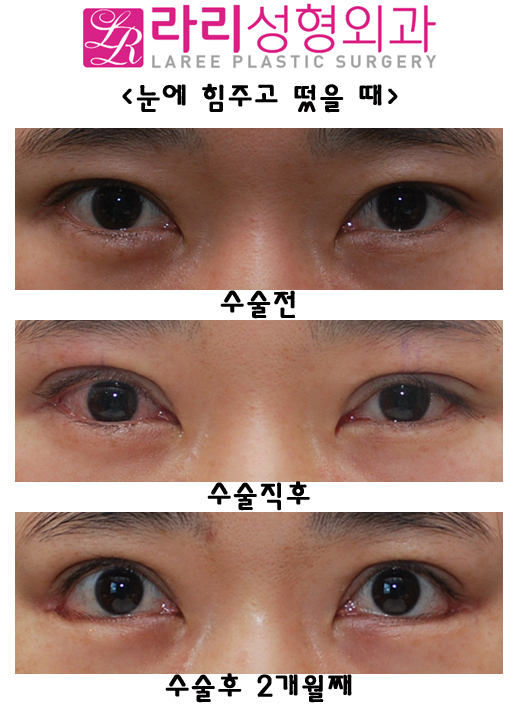 비절개눈매교정술과 뒤트임재수술 함께 한다면 관련 이미지 2
