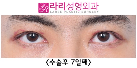 [라리성형외과] 쌍꺼풀없애기 수술 눈안감김(토안)의 원인이 정말 피부절제 때문일까? - 무절제쌍꺼풀없애기 관련 이미지 18